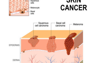 Types of Skin Cancer