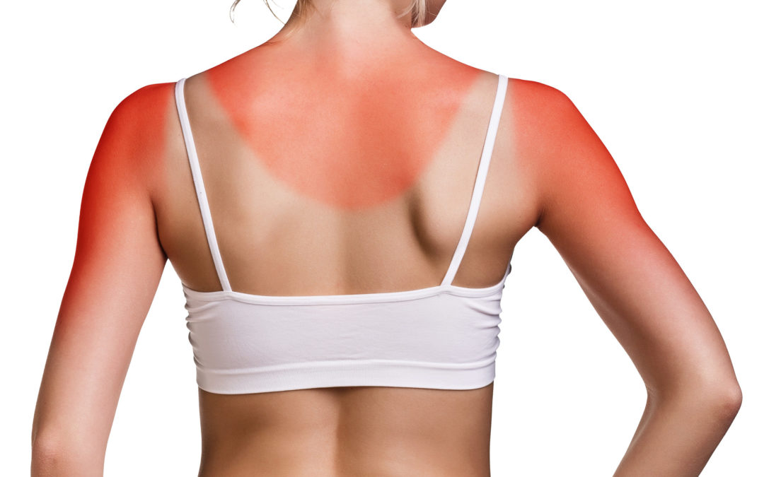 Preventing Skin Cancer After Sunburn