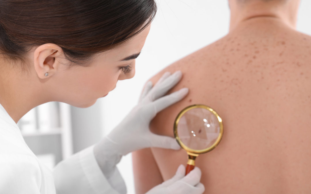 Are You at Risk for Skin Cancer?