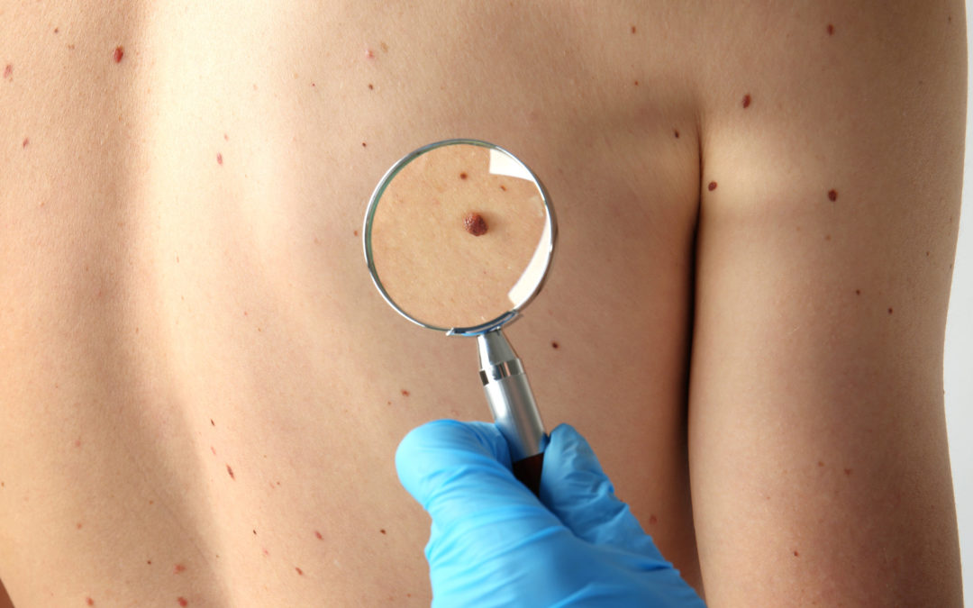 The Difference Between Melanoma & Nonmelanoma Skin Cancer