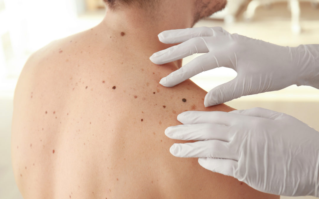 The Different Types of Skin Cancer