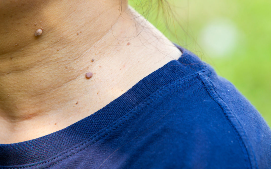 Signs You Should Have a Mole Checked