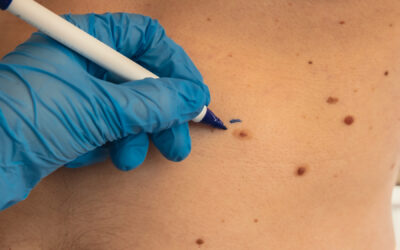 Why Some Skin Cancers Come Back and How Mohs Surgery Prevents Recurrence